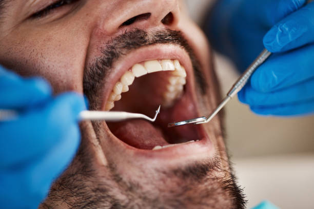 Best Emergency Dental Care for Broken or Chipped Teeth in Kingsville, MD
